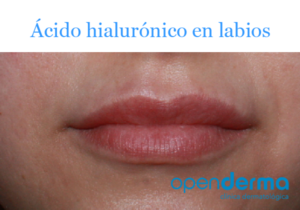 acido hialuronico labios openderma murcia