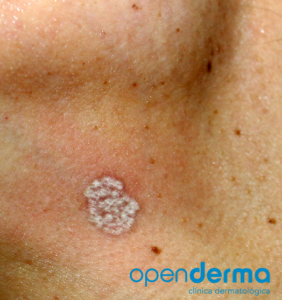 mancha tratada openderma murcia