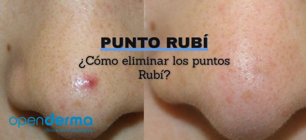 como eliminar punto rubi openderma murcia