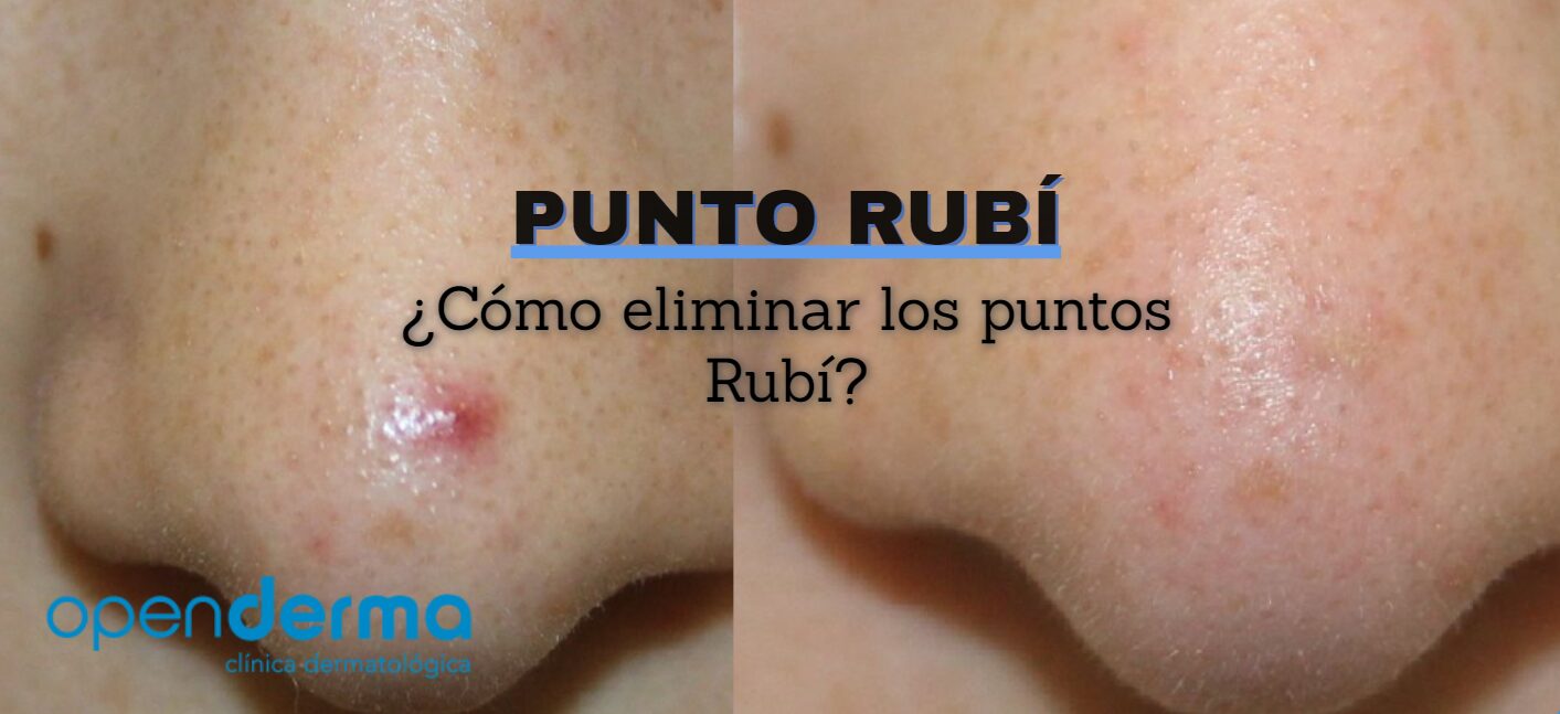 como eliminar punto rubi openderma murcia