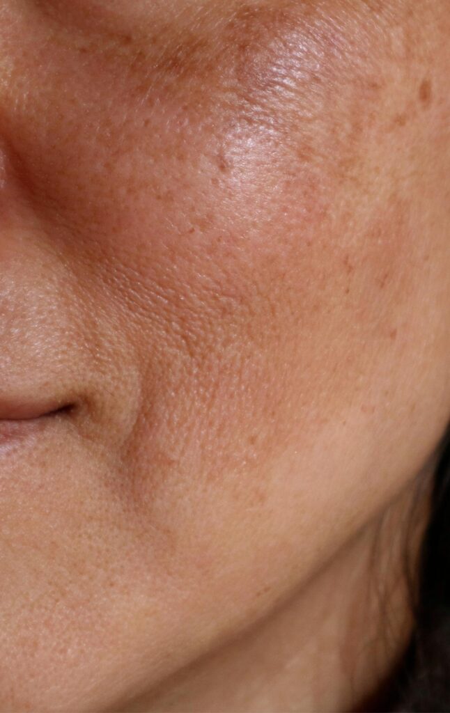 MELASMA OPENDERMA DERMATOLOGIA