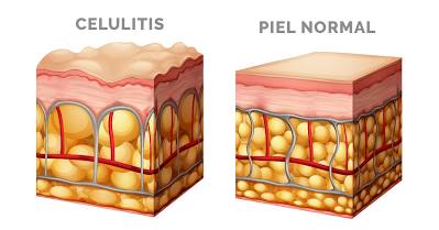 celulitis2