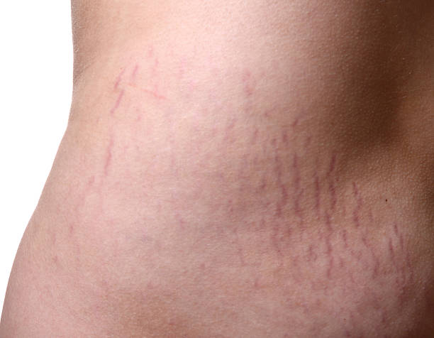 Stretch Marks on human skinSEE ALSO: