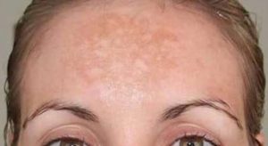 melasma 639x350 300x164 1