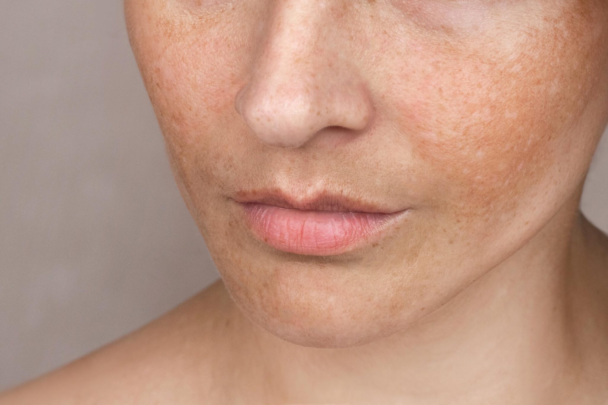 melasma-manchas-openderma-murcia (2)