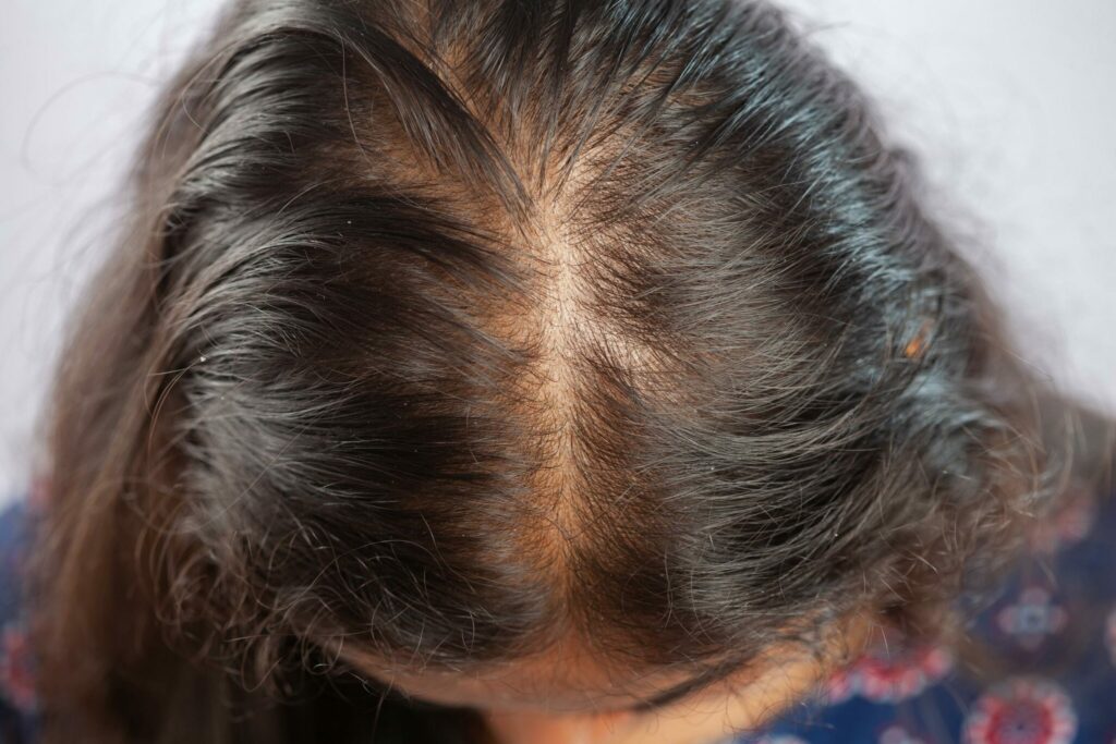 openderma alopecia femenina