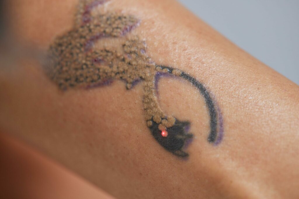 openderma laser eliminar tatuajes