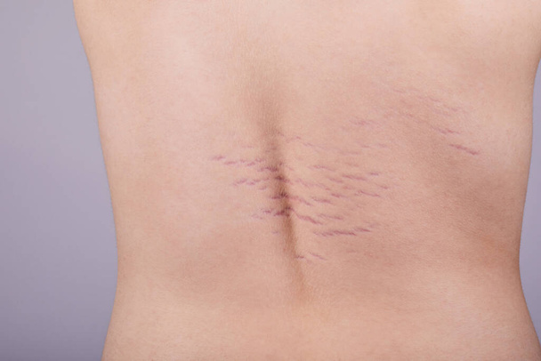 stock-photo-close-view-back-striae-distensae-striae-rubrae-skin-concept-impaired