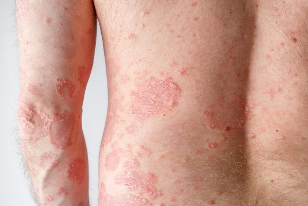 Psoriasis