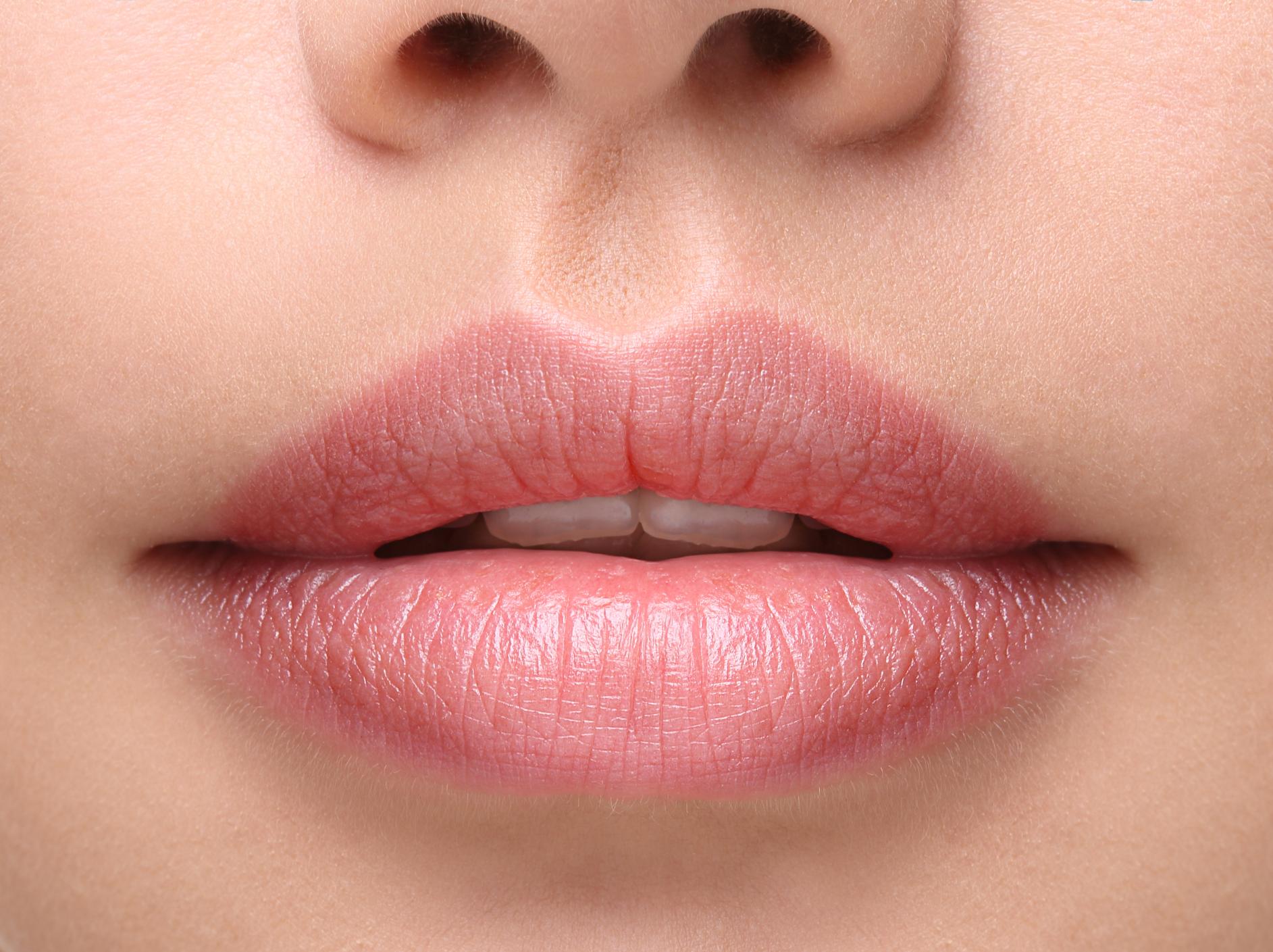 lip-lift-cirugia-plastica-openderma-murcia (3)